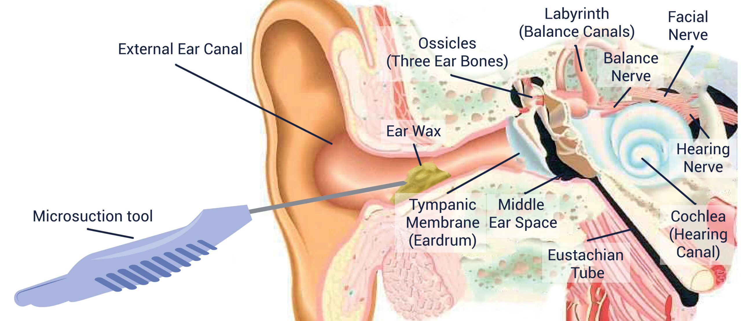 Detailed anatomical illustration of the human ear with a microsuction tool near the external ear canal